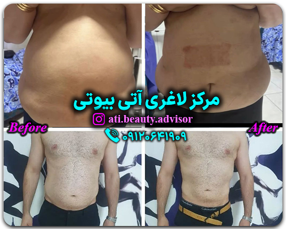 مرکز لاغری آتی بیوتی
